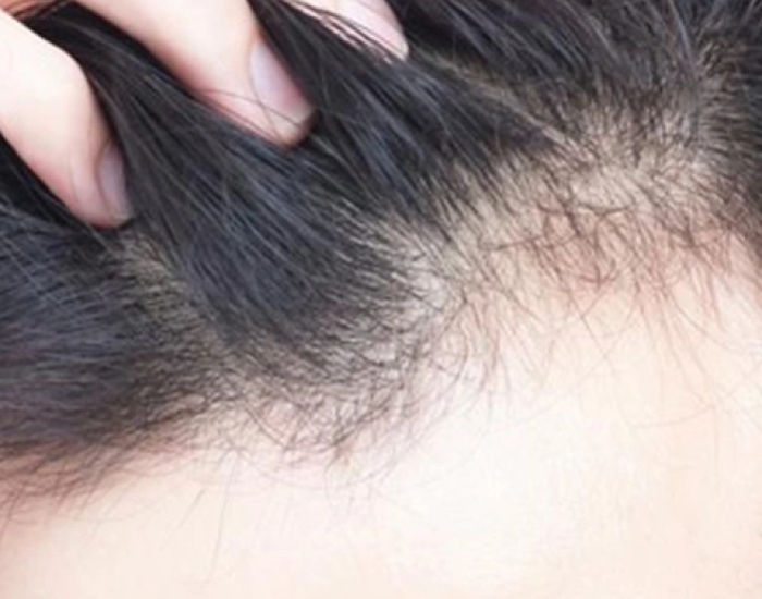 Rụng Tóc Tập Trung Phần Trán ( 90 Phút)
