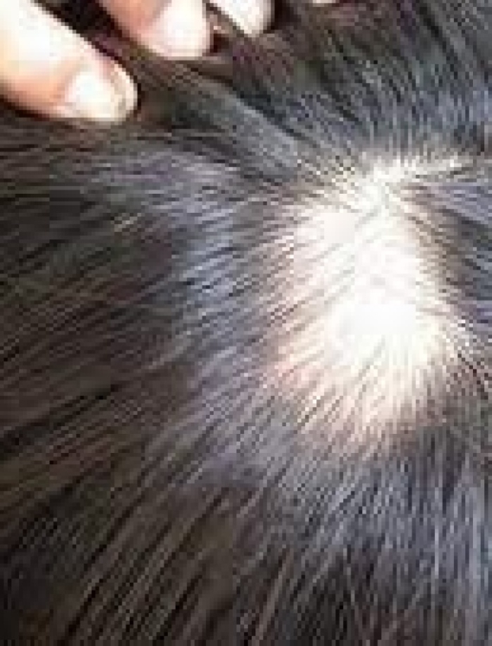 Rụng tóc theo mảng (90 Phút)